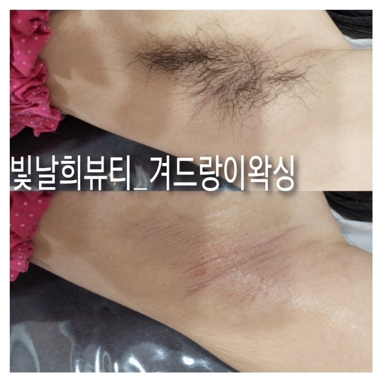  겨드랑이왁싱 한달에 한번 필수관리