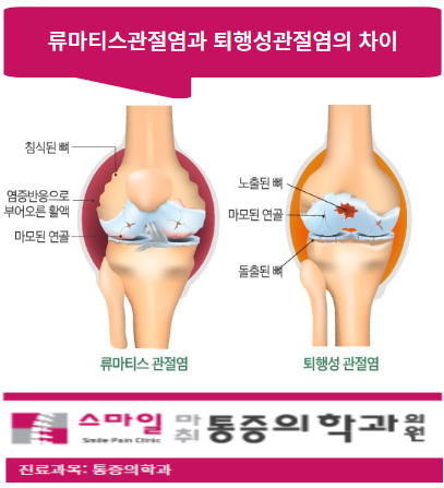  [일산무릎관절치료병원] 류마티스관절염과 퇴행성관절염의 증상차이