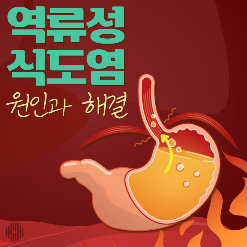 역류성 식도염 약을 먹고도 계속 일어나는 이유는 (1) 11
