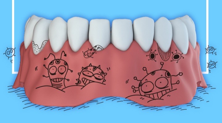 스케일링 후 치아관리 :: 치은염 치주염 예방