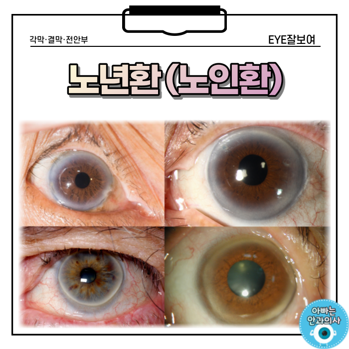  나이 들고 눈동자가 하얗게 변한다면? - 노년환, 노인환