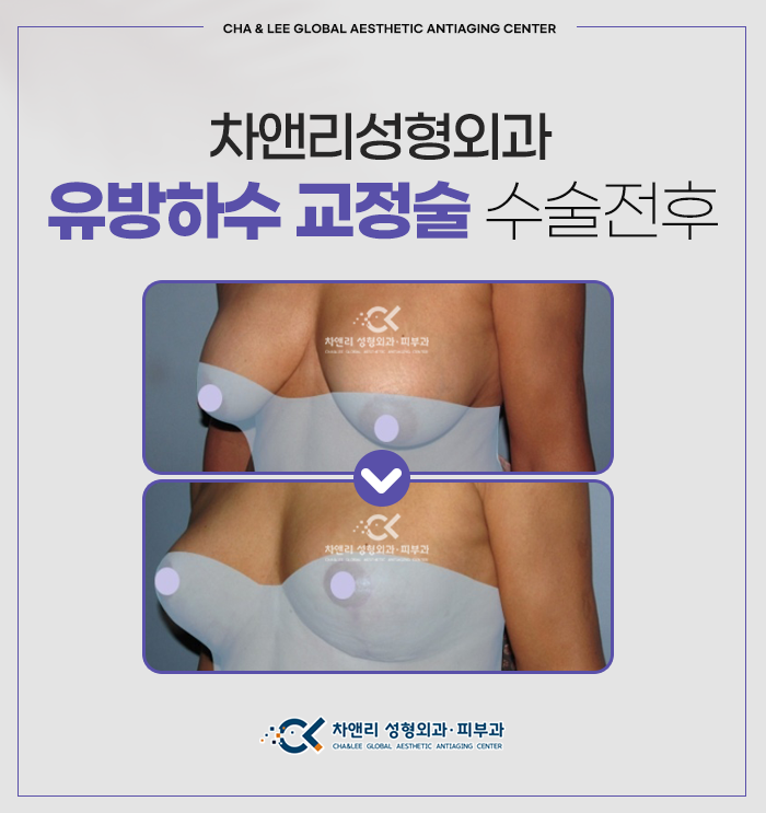  출산후 가슴처짐, 유방하수 교정수술로 가능합니다.
