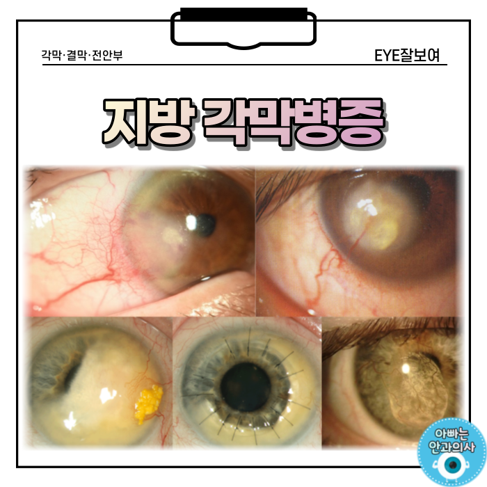  각막에 지방이 쌓이는 '지방각막병증'