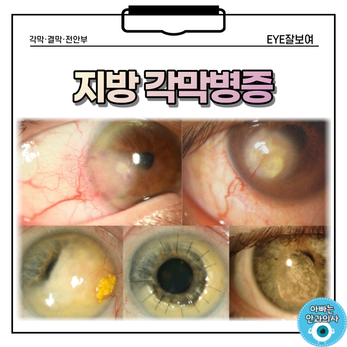 각막에 지방이 쌓이는 '지방각막병증'