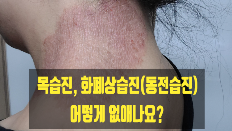  목습진, 화폐상습진(동전습진) 어떻게 없애나요?