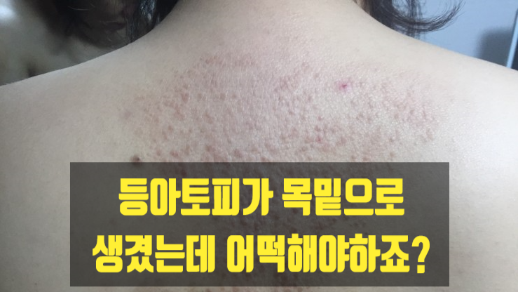  등아토피가 목밑으로 생겼는데 어떡해야하죠?
