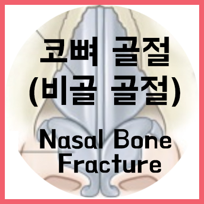  [코] 코뼈 골절(비골 골절, Nasal bone fracture)