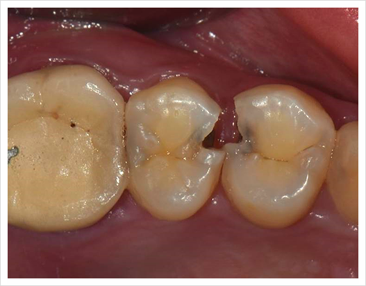 응암동치과&lt; 손상된 치아를 발치 없이 보존적으로 치료하는 방법의 증례. &gt;