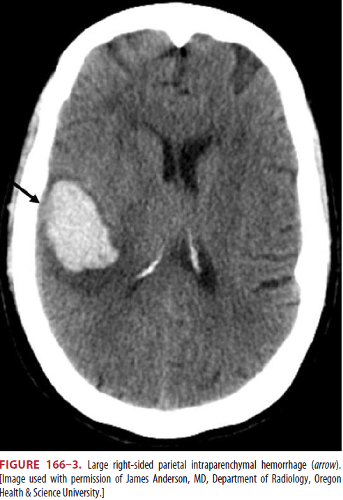 Intracerebral hemorrhage (뇌내출혈, ICH)