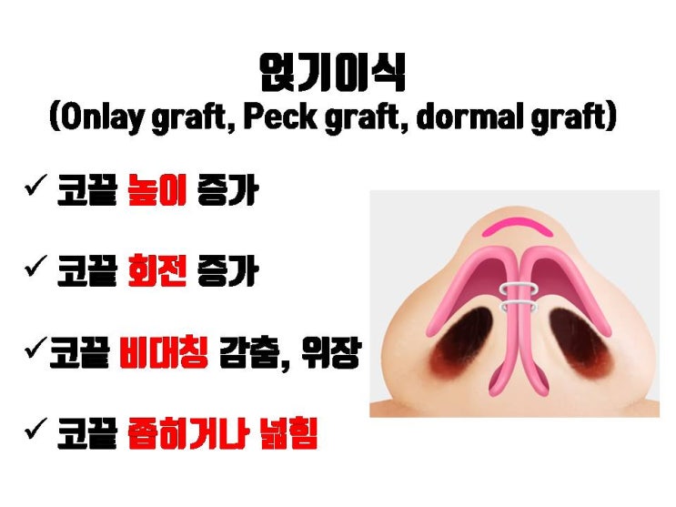  코수술 후 이식된 연골 비침과 이동을 동시에 막을 수 있는 코끝성형!!!