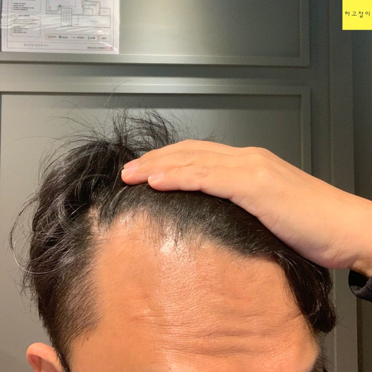  탈모원인 6가지 알아봤어요