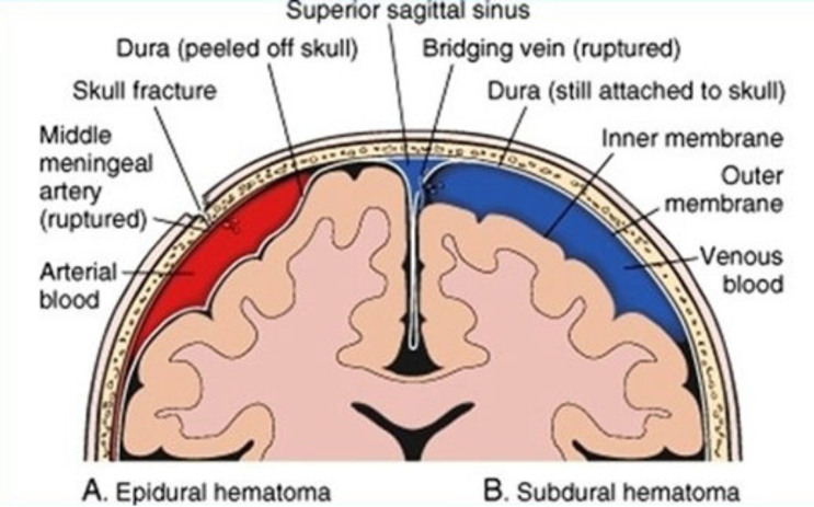 Head trauma - EDH, SDH (경막외혈종, 경막하혈종)