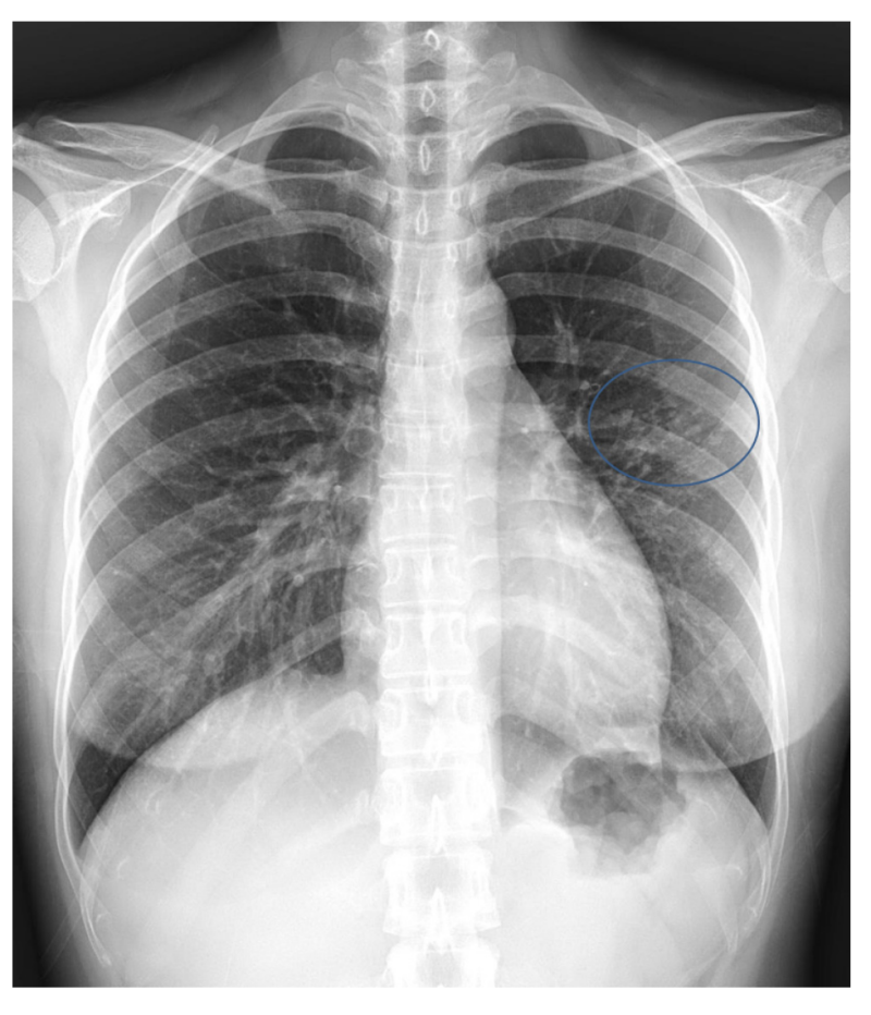 활동성 폐결핵 폐엑스레이 x-ray 증례, 증상, 특징 소견, 폐결절, CT 소견 : 네이버 블로그