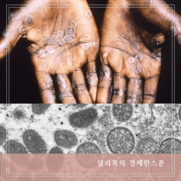  원수이두창 원인과 증상 전염 경로 사람 간 접촉으로 감염 유행 가능성