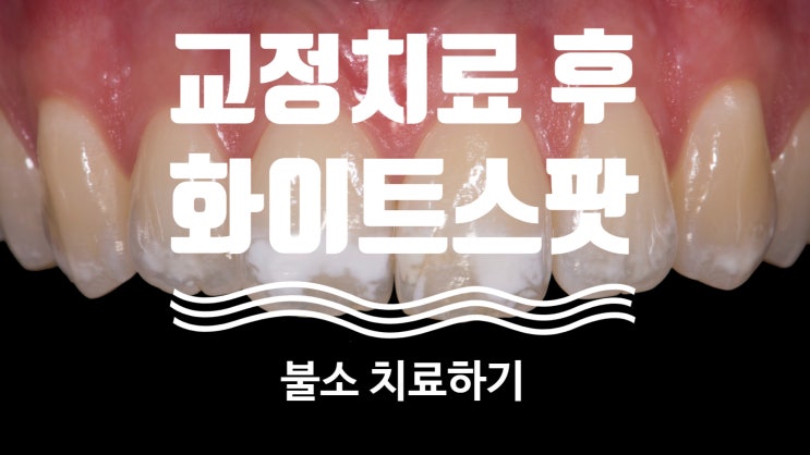 교정치료 후 발생된 화아트스팟(white spot)에 도움을 주는 불소 교정치료 후 발생된 화아트스팟(white spot)에 도움을 주는 불소