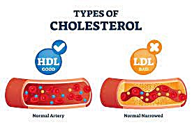 콜레스테롤 LDL 저밀도 HLD 고밀도 세포 막 지방 소화 혈관 뇌경색 심근 경색
