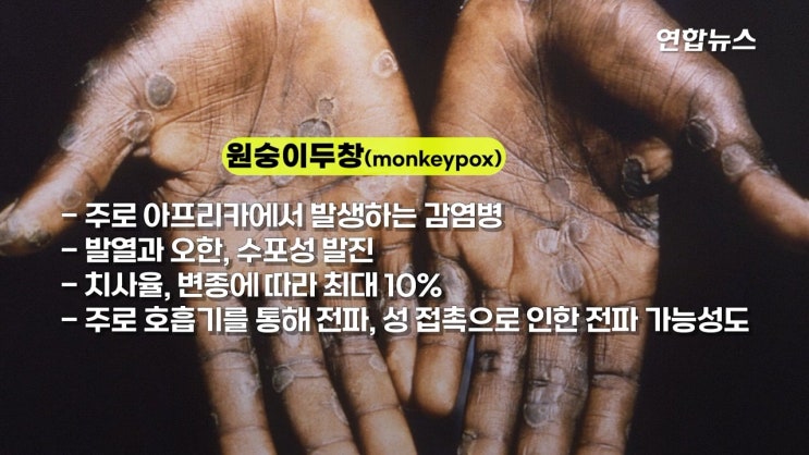 원숭이두창 바이러스 전세계 확산 치사율10% 또 다른 전염병 호흡기로 전파 동성간성관계 원숭이두창 바이러스 전세계 확산 치사율10% 또 다른 전염병 호흡기로 전파 동성간성관계