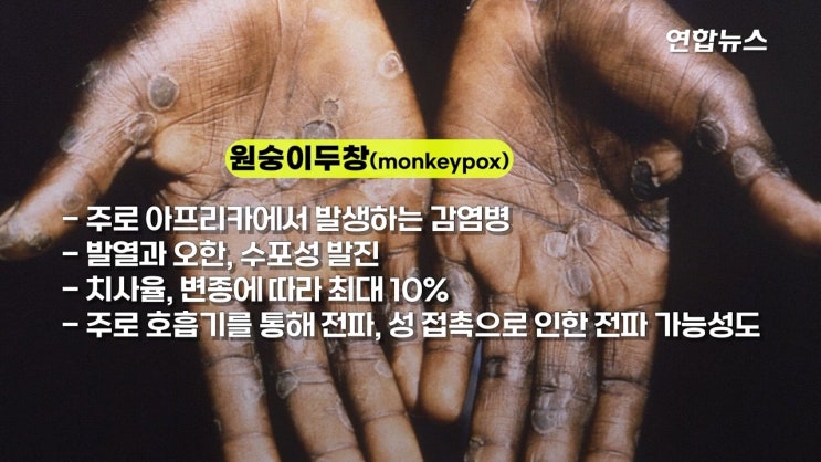 원숭이두창 바이러스 전세계 확산 치사율10% 또 다른 전염병 호흡기로 전파 동성간성관계