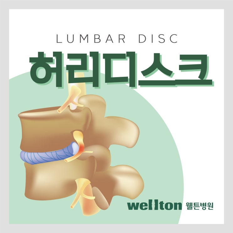  양방향 척추 내시경 넓은 시야 확보로 허리디스크 병변을 확실하게 치료!