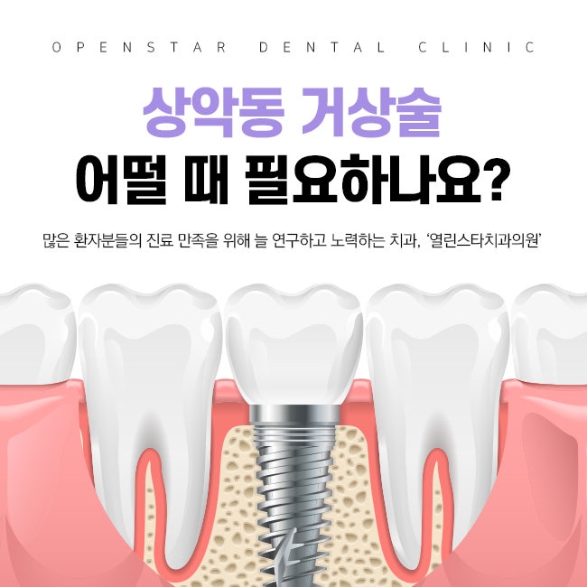Multi-Sinus Dental 상악동 리프팅 치과를 선택하는 것이 왜 중요한가요? 5