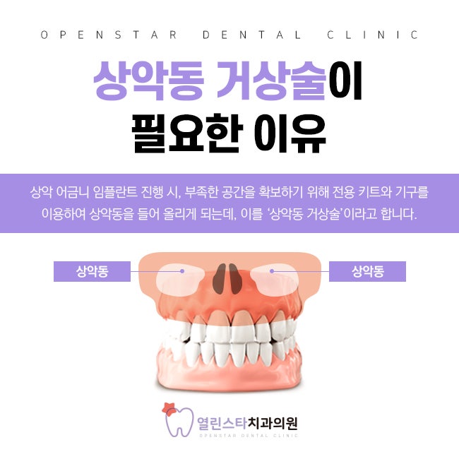 Multi-Sinus Dental 상악동 리프팅 치과를 선택하는 것이 왜 중요한가요? 3