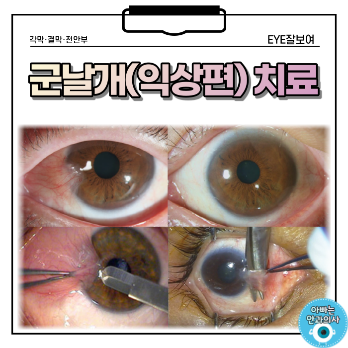  검은동자 위로 자라는 흰살, 치료는? - 군날개, 익상편 (2)
