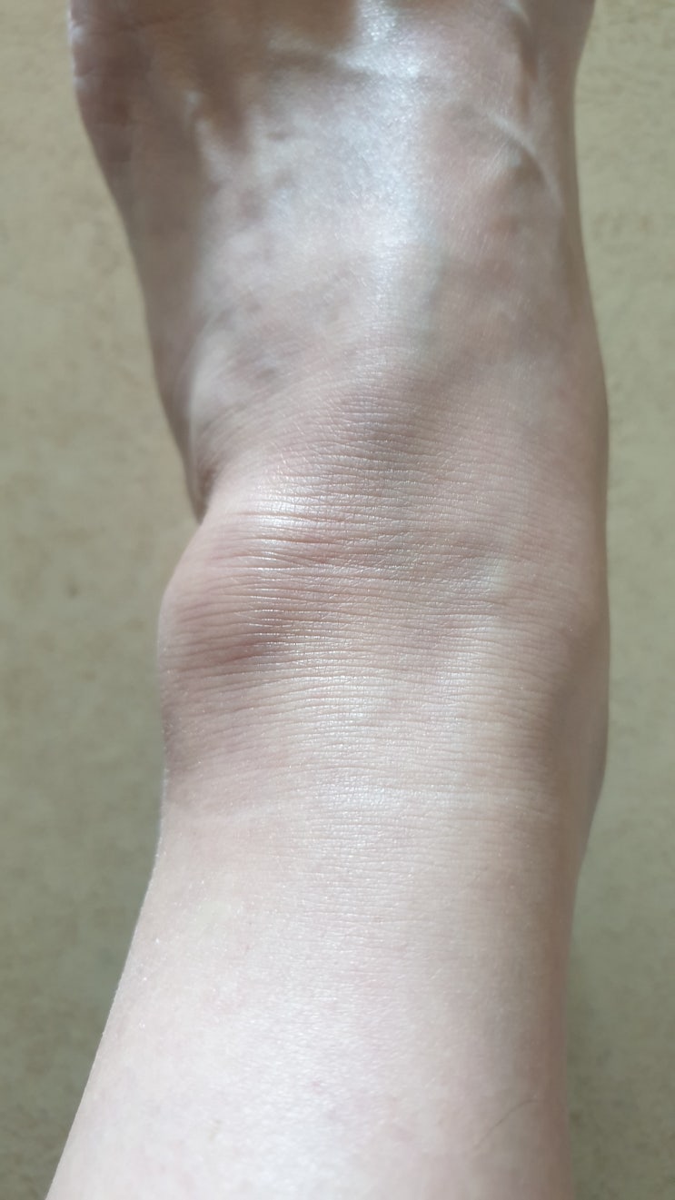 발목 염좌..이리 오래 갈 일인가?!ㅠㅠ