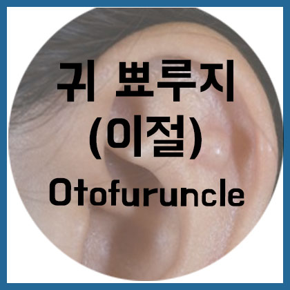  [귀] 귀 뾰루지, 이절(Otofuruncle)