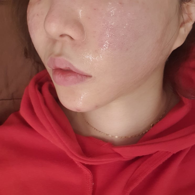  로이성형외과 신사역 엑소좀 2주후기
