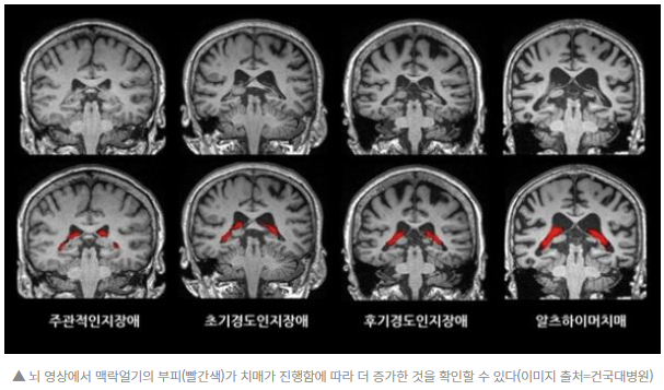  뇌 속 '이것' 크면, 알츠하이머 치매 위험이 커진다