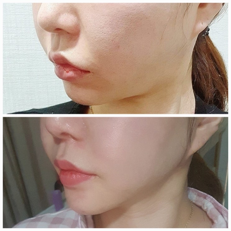  침샘보톡스 효과 NS윤곽주사 한달 후기 in 강남피부과