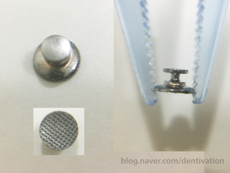  [치과 교정 소재료] 교정용 버튼 (button)