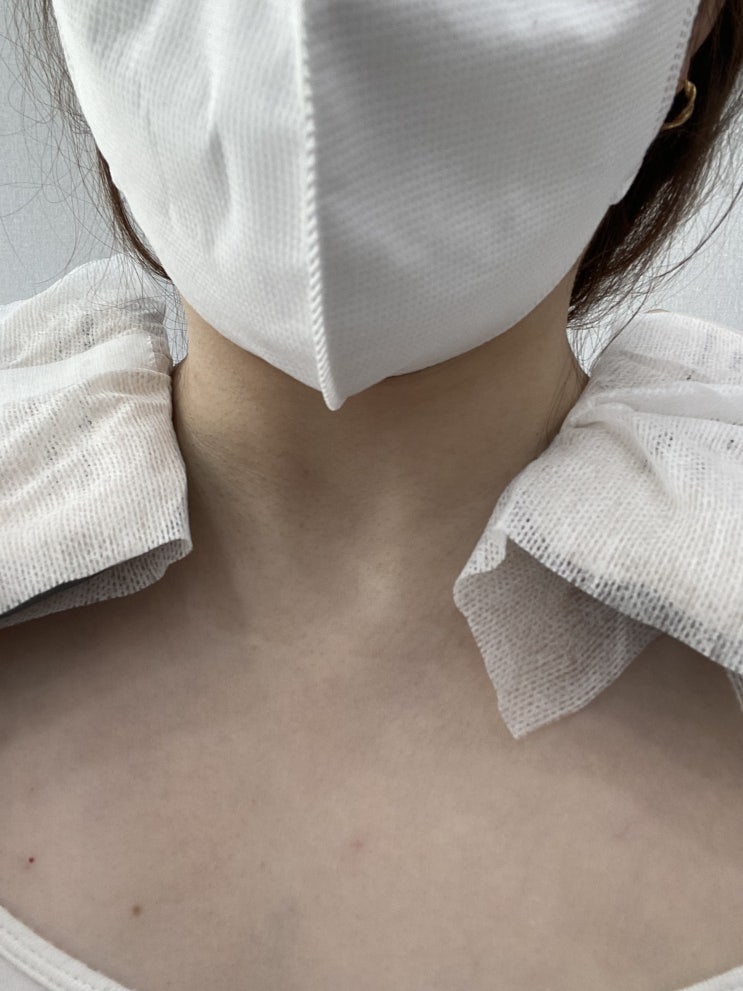  수원 수지피부과 결혼 준비 필수 승모근 보톡스 후기 및 가격