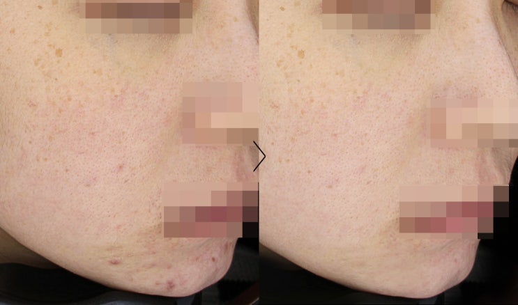  뷰티라운지의원천안 여드름으로 인한 색소침착이 남았을 경우