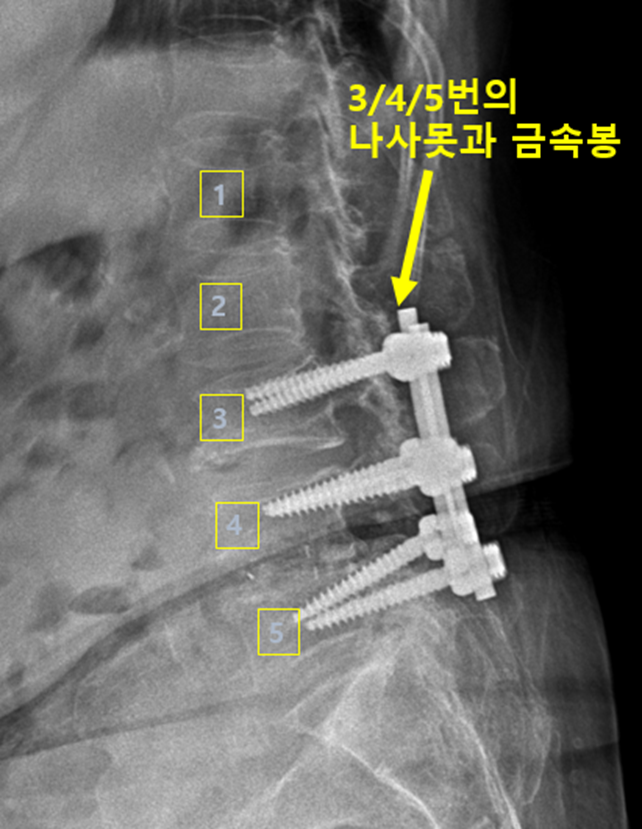 수술 후 7년뒤 지속되는 통증, 신경차단술로 치료 합니다. (인접분절질환 치료 사례)