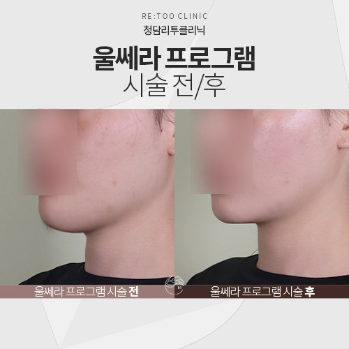 수원울테라? 부작용 없는 노하우 공개