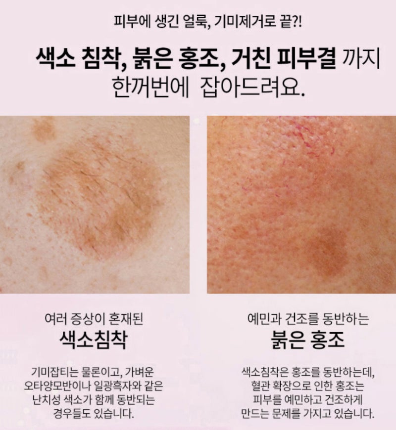 기미, 주근깨, 색소침착 레이저토닝 시술후기 1 (플랙셀 듀얼, BBL 쥬레이저, 레브라이트) 6