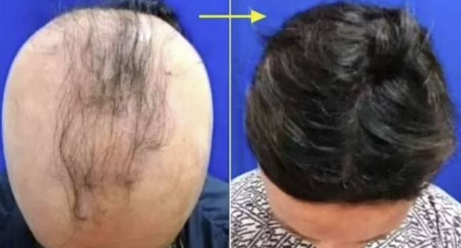 "원형 탈모 환자 80% 다시 자랐다"…미국서 신약 개발 화제 "원형 탈모 환자 80% 다시 자랐다"…미국서 신약 개발 화제
