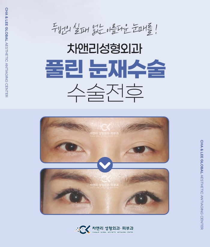  절개 쌍커풀수술후에도 자꾸 풀린다면?
