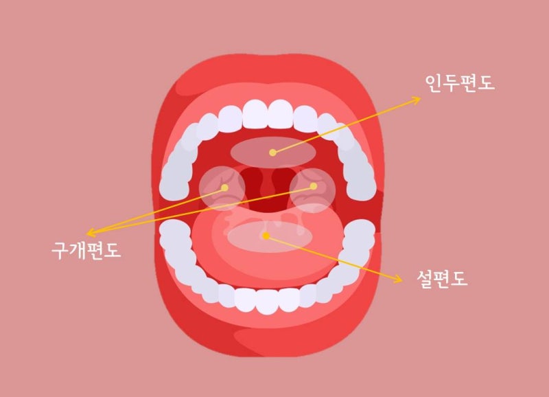 편도염 증상 고열 오한 목 아플 땐 의심을