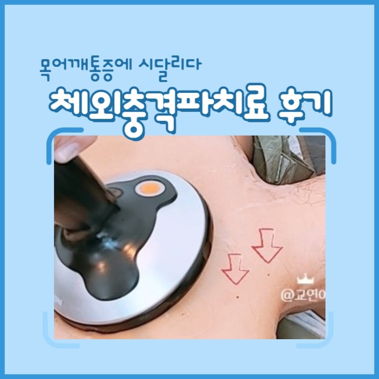 근막통증증후군 어깨근육 체외충격파치료 통증 치료기 근막통증증후군 어깨근육 체외충격파치료 통증 치료기
