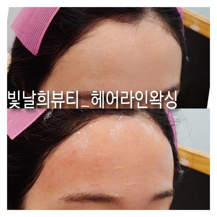  답답한이마 헤어라인왁싱으로 깔금하고 시원하게 디자인잡기