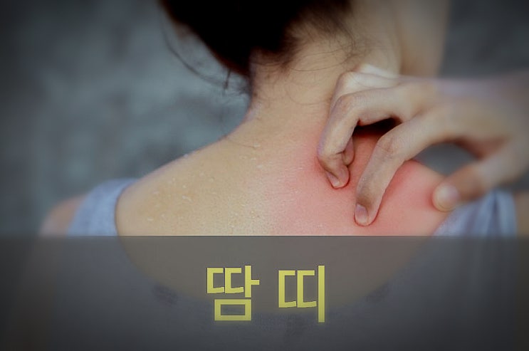 성인 겨드랑이 땀띠 원인, 증상, 예방: 치료(약, 연고)