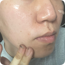 여드름후유증 트러블피부에 좋은 이지듀 카밍컨트롤 3단계 제품 사용 후기 여드름후유증 트러블피부에 좋은 이지듀 카밍컨트롤 3단계 제품 사용 후기