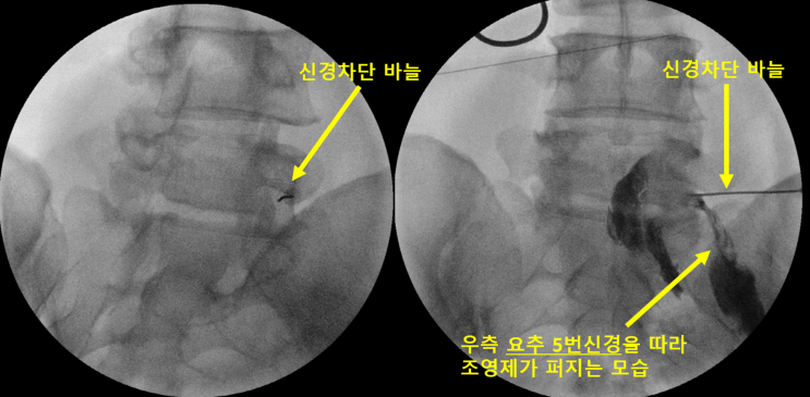  신경주사 맞을 때 다리가 찌릿한게 괜찮은 건가요?