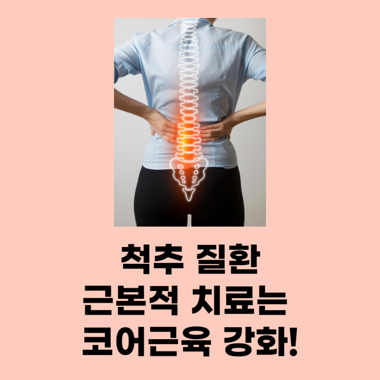 척추 질환, 근본적 치료는 코어근육 강화!(쉬운 운동방법소개)