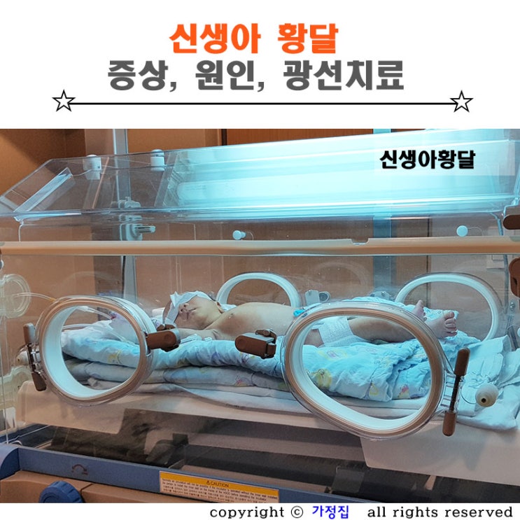  신생아 황달, 아기 모유황달 증상, 원인, 광선치료