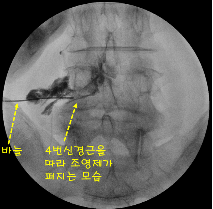 방사통만 있는 요추전방전위증 신경차단술로 치료 합니다.
