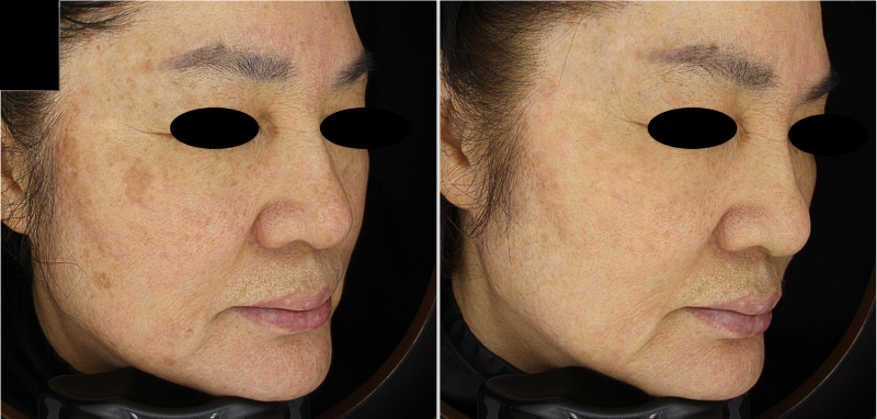 고토구 기미, 주근깨, 멜라닌 색소침착을 한번에