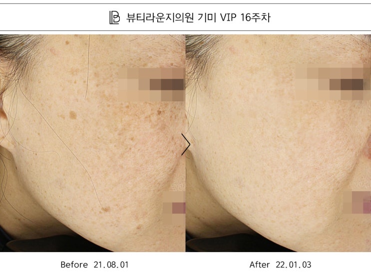  뷰티라운지의원강남 기미/잡티 피코플러스 피코슈어 피코하이등 피코레이저의 추천이유